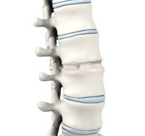 Anterior Lumbar Interbody Fusion