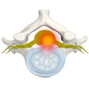 Cervical Disc Protrusion