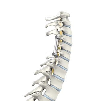 Cervical Spine Fusion