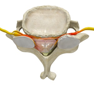 Cervical Stenosis