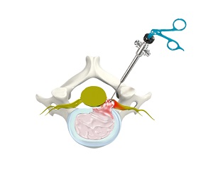 Discectomy and  Fusion