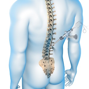 Endoscopic Spine Surgery