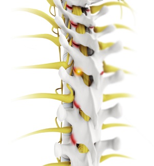 Facet Joint Arthritis