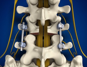 Fracture Stabilization