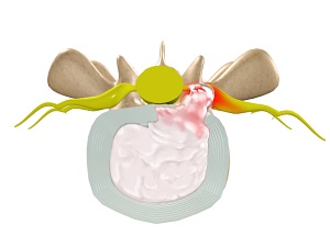 Herniated Disc