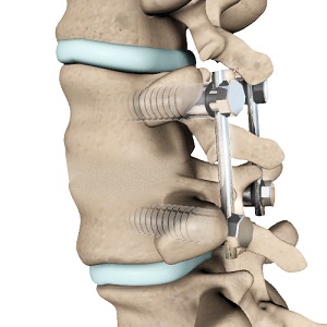 Lumbar Fusion