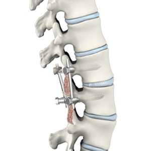 Lumbar Spinal Fusion