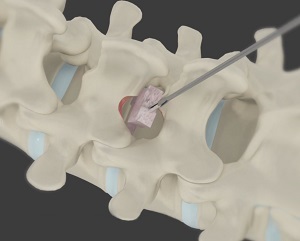 Minimally Invasive Discectomy & Decompression