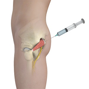 Piriformis Muscle Injection