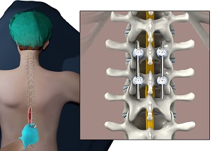 Posterior Thoracic Fusion