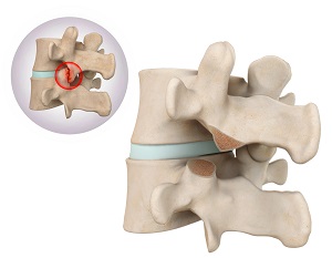 Removal of Facet Joint Cyst