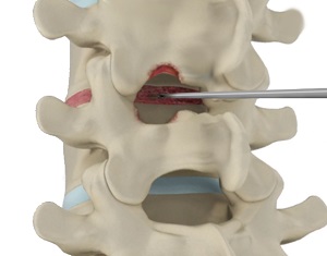 Spinal Decompression Therapy