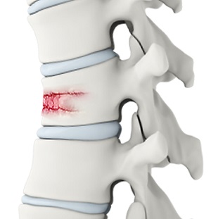 Spinal Fracture