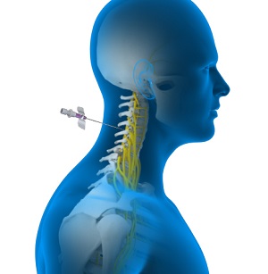 Spinal Nerve Blocks