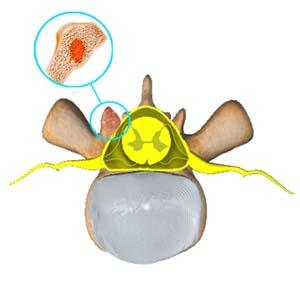 Spinal Tumors