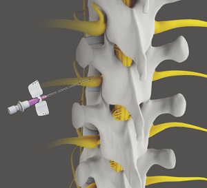 Spine Injections