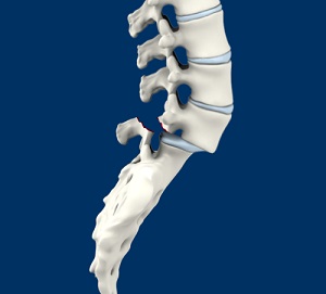 Spondylolisthesis