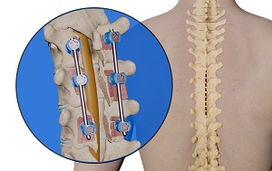 Thoracic Corpectomy