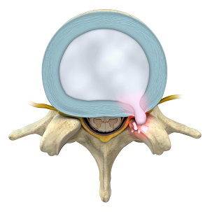 Thoracic Disc Herniation