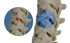 Thoracic Facetectomy