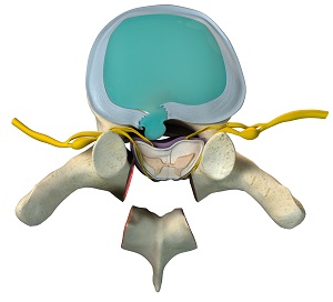 Thoracic Spine Decompression