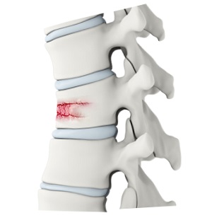 Thoracic Spine Fracture Repair Surgery