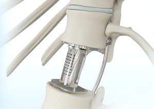 Thoracic Vertebrectomy