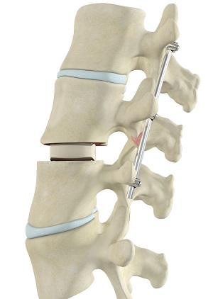 Transforaminal Lumbar Interbody Fusion