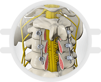 Cervical Spine Surgery