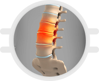 Degenerative Disc Disease