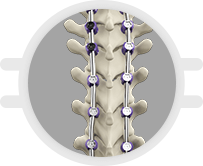 Spine Deformity Surgery